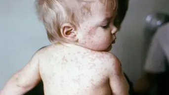 Call for increase in measles vaccinations in Gauteng Call for increase in measles vaccinations in Gauteng