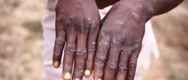 Gambia declares mpox outbreak Gambia declares mpox outbreak
