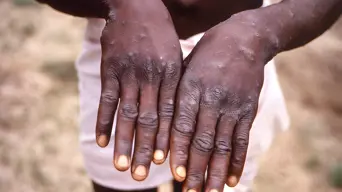 Gambia declares mpox outbreak Gambia declares mpox outbreak